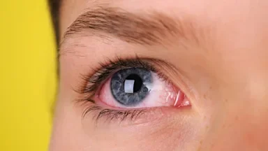 Extreme close-up of a person's eye. This person is experiencing red bloodshot eyes.
DawnPoland/E+ via Getty Images
