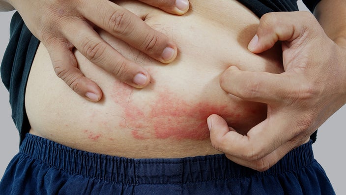 Close-up stomach rash.