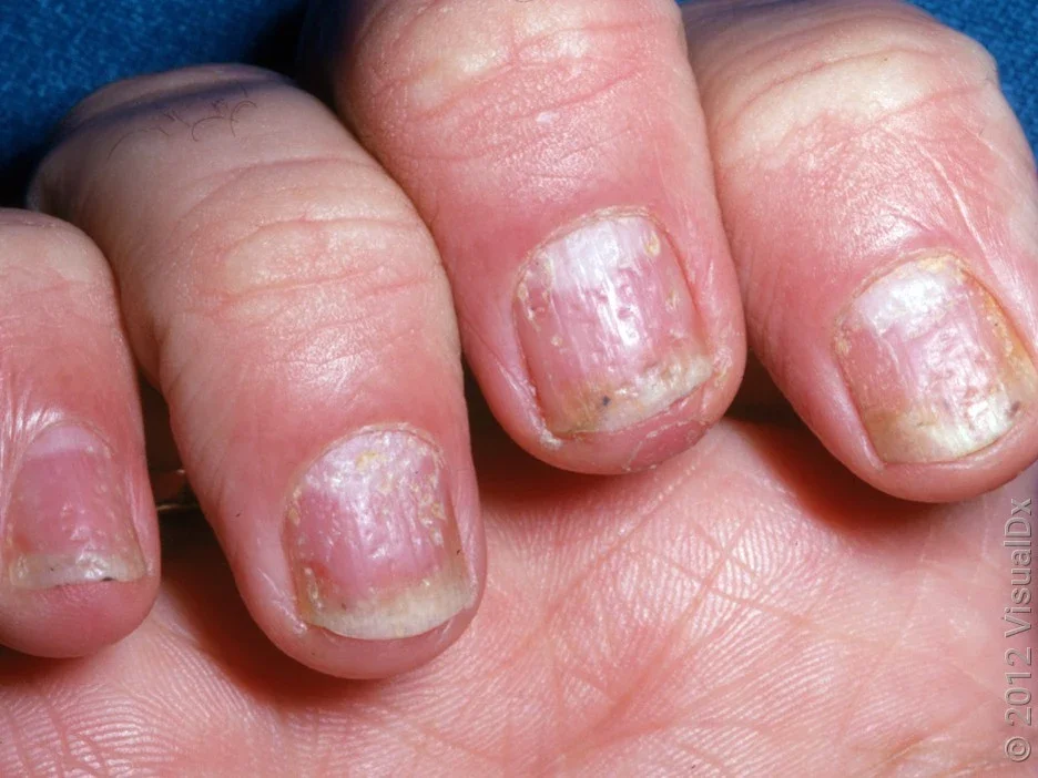 Close-up of fingernails with pits and discoloration from psoriasis. 