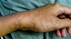 Chronic spontaneous urticaria (CSU), or chronic hives, are recurrent episodes of itchy, red patches on the skin that come and go for 6 weeks or longer. Learn more about causes, treatment, and signs of chronic hives.