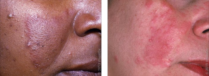 Left: Close-up of a cheek with purplish patches and skin bumps (rosacea). Right: Alt text: Close-up of a cheek with red patches and skin bumps (rosacea).
