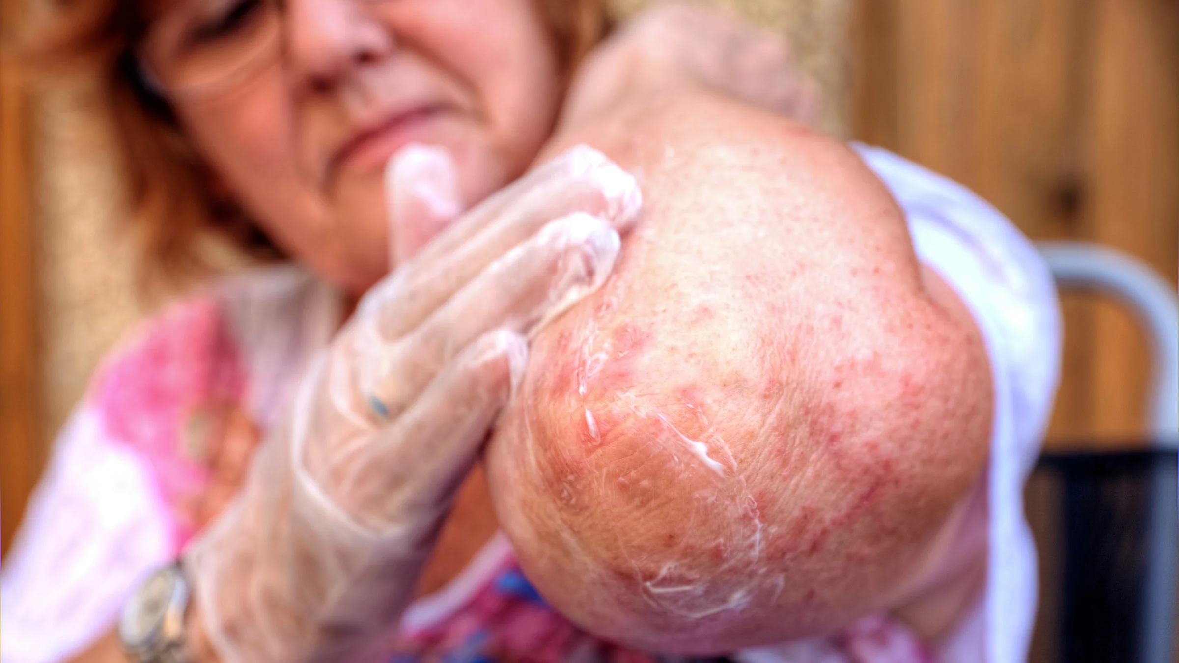 A person rubbing eczema cream on their elbow.