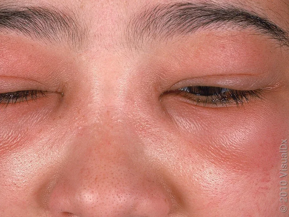 Angioedema of the eyelids. 