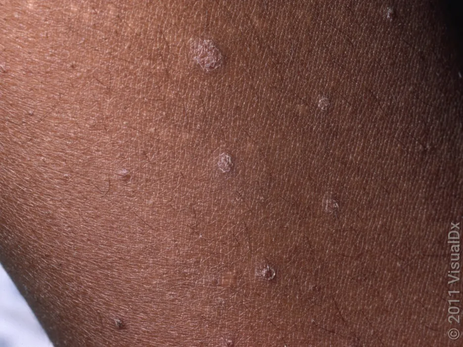 Close-up of small, round, scaly patches in guttate psoriasis.
