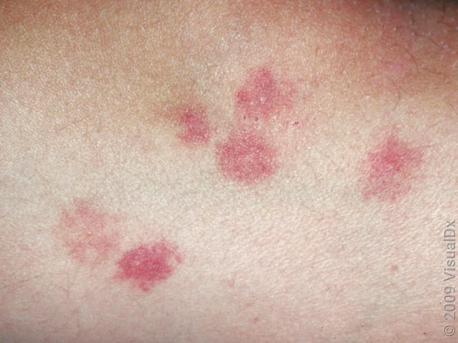 Close-up of bedbug bites on the arm.