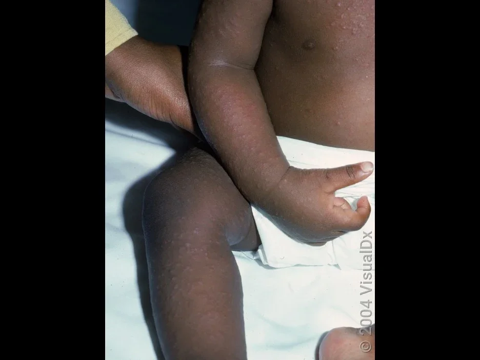 A morbilliform rash on Black skin. 