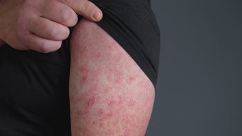 Skin Infection: closeup rash on arm 1401356599