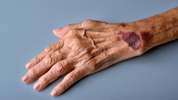 autoimmune: hand: bruise: senior persons bruised hand-1237596244