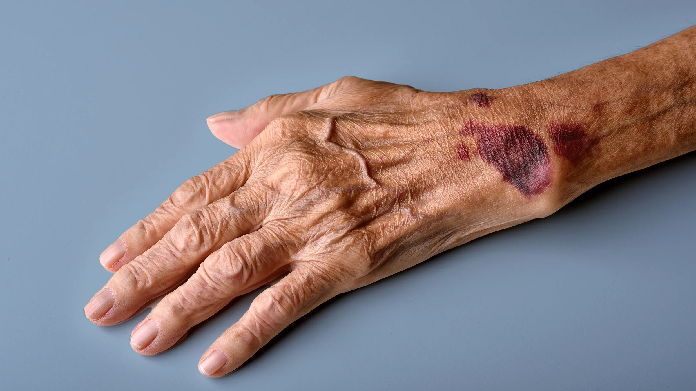 Close-up on an older adult’s hand with big blood bruises.