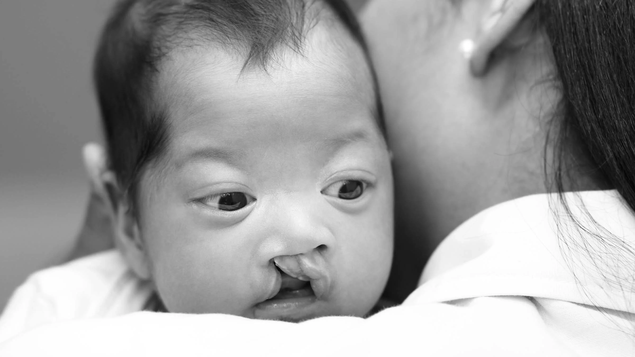 Black and white portrait of a newborn baby with a cleft lip. The parent is holding them over their shoulder.