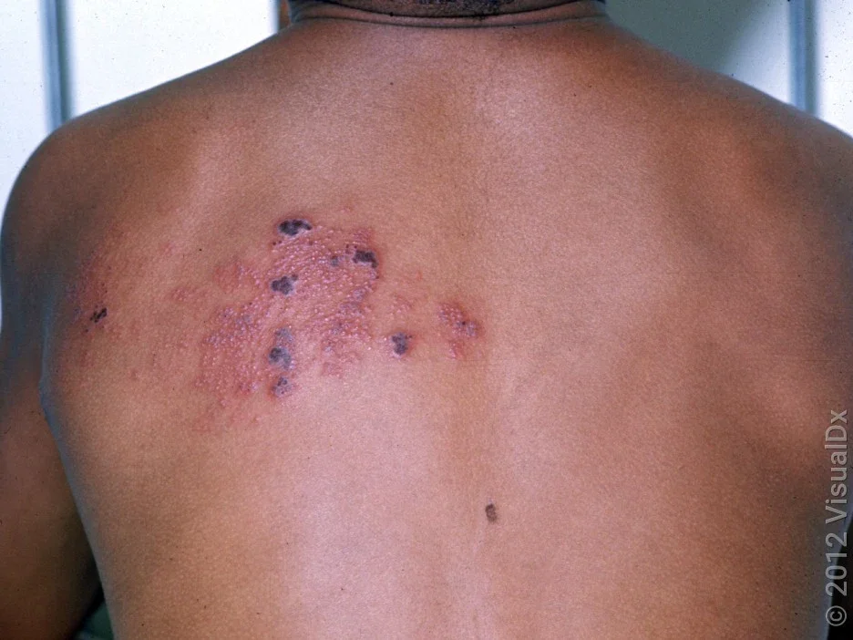 Shingles outbreak on the back. 