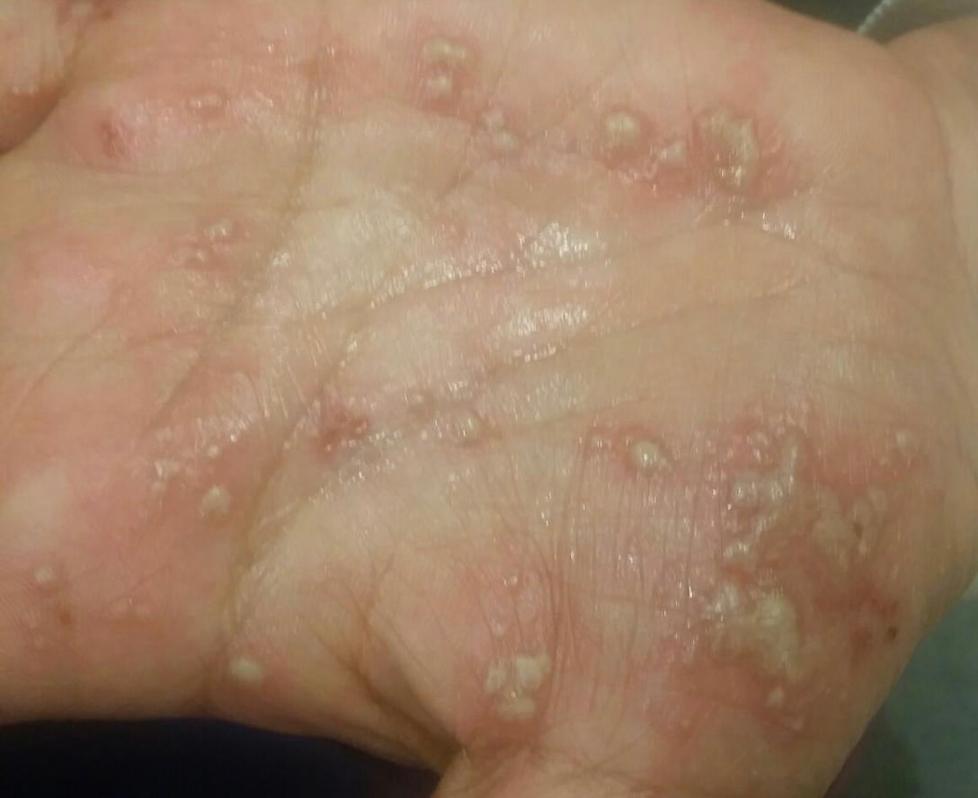 Is That Rash Psoriasis? Psoriasis Pictures and More