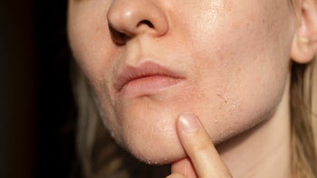acne: closeup dry skin 1783774300