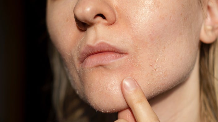 Close-up woman with dry skin.