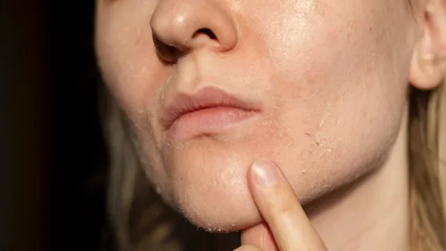 acne: closeup dry skin 1783774300