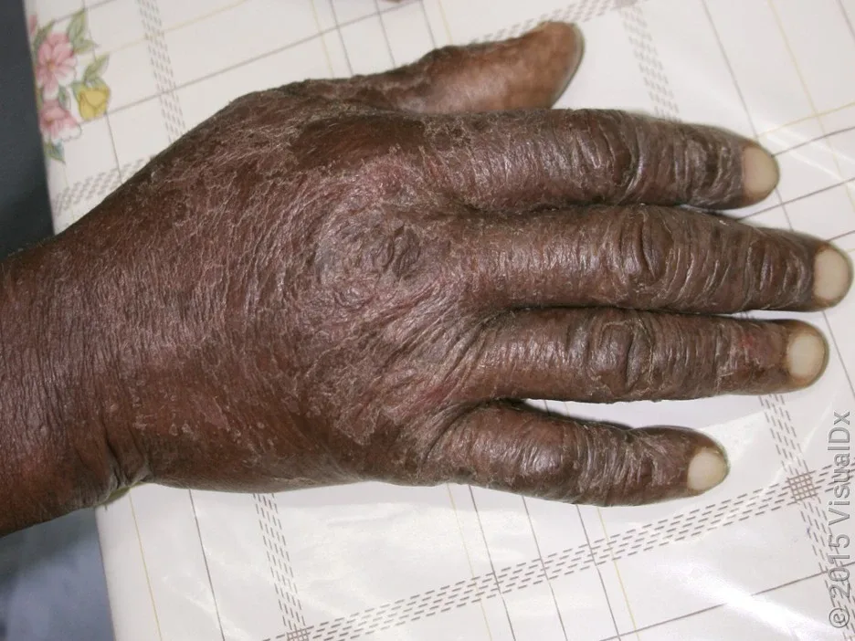 What severe eczema looks like on the back of the hand. 