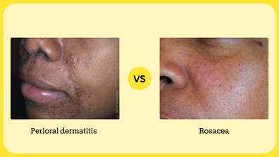 Muzzle Rash What Does Perioral Dermatitis Look Like? - GoodRx