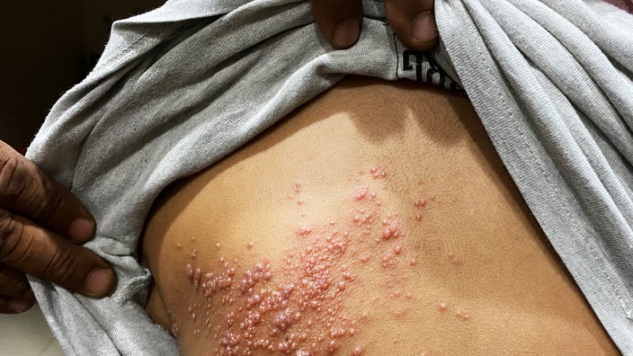 Close-up of shingles rash on a person’s back