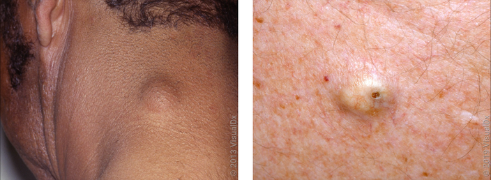 Left: A large, smooth skin bump on the back of the neck. Right: Close up picture of a large, smooth skin bump with a tiny central opening.