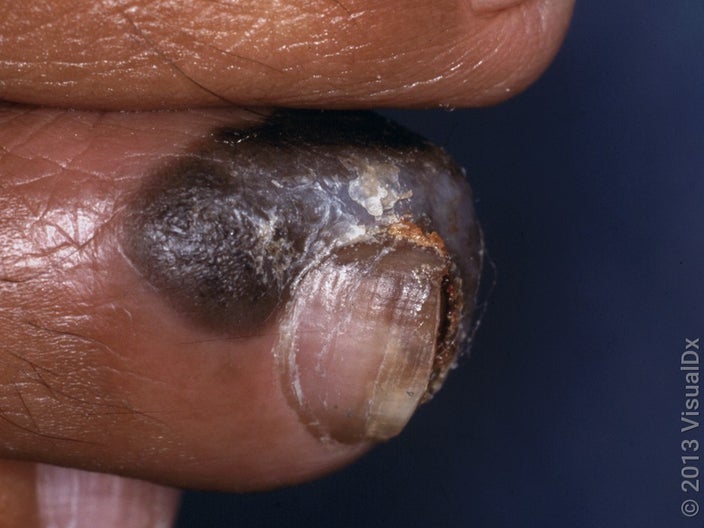Close-up of melanoma on the toe in darker skin. 