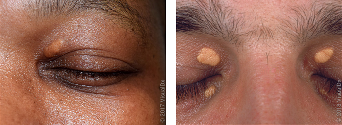 Left: A single tan-yellow flat skin growth on the upper eyelid. Right: Large, flat, yellowish skin growths on the upper and lower eyelids. 