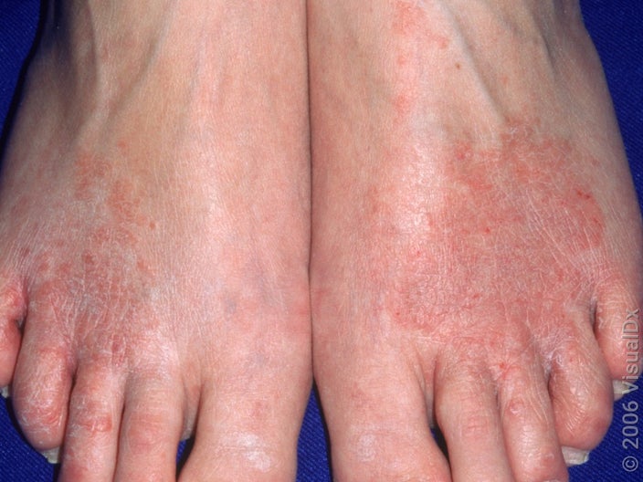 Close-up of ringworm on the feet (athlete’s foot).