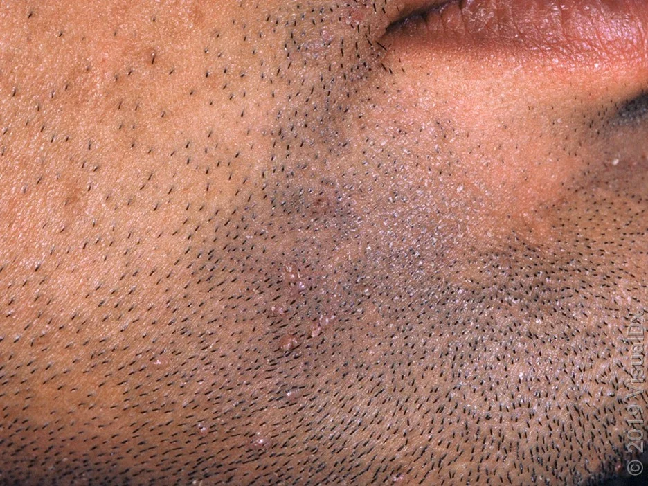 Flat warts are common in the beard area, and are spread by shaving.