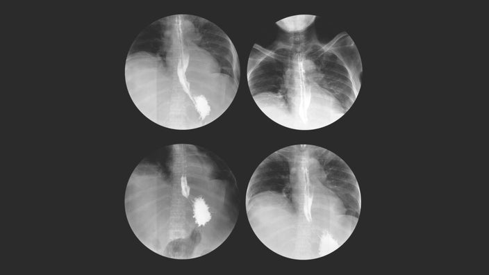 Black and white image of four circle x-ray images. They show the esophagus and digestive system of a person who swallowed barium.