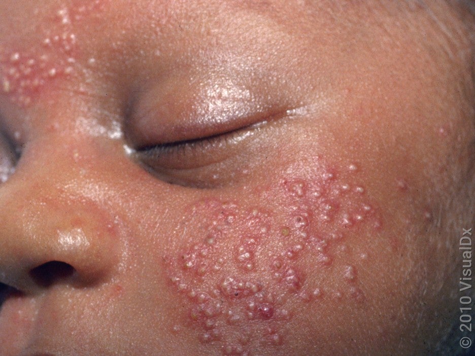 How to Know If Your Baby Has Acne, Plus Signs to Look For GoodRx