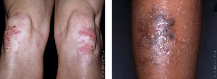 Left: Pink sores and crusts on the knees in autoimmune dermatitis herpetiformis. Right: Close-up of blisters and dark patches on the shin rm in autoimmune dermatitis herpetiformis.