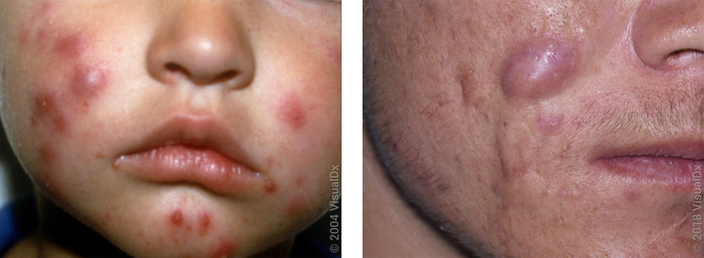 Red pimples on face hotsell
