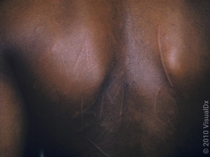 Close up of dermatographism on the back. 
