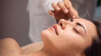 Health: allergies: facial acupuncture-1356339790