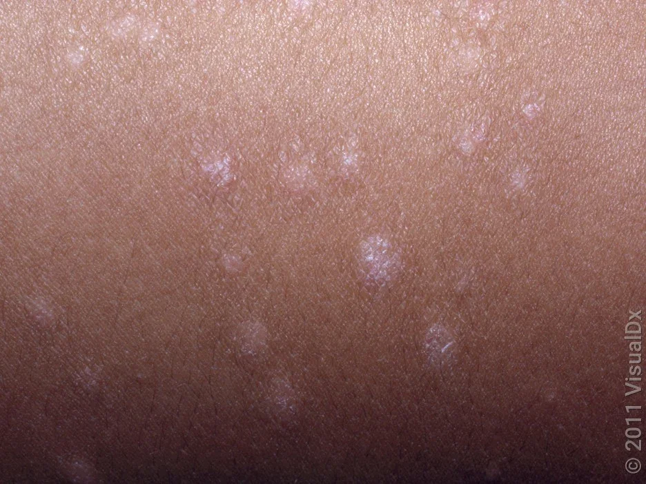 Close-up of guttate psoriasis on darker skin. 