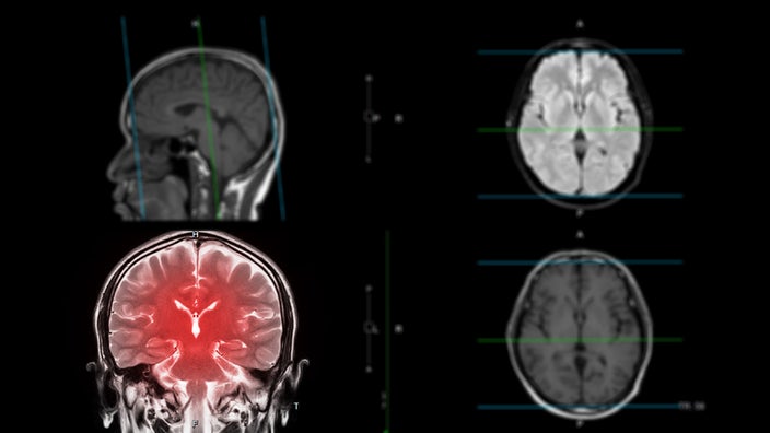 A black and white brain scan shows the affected area highlighted in red. 