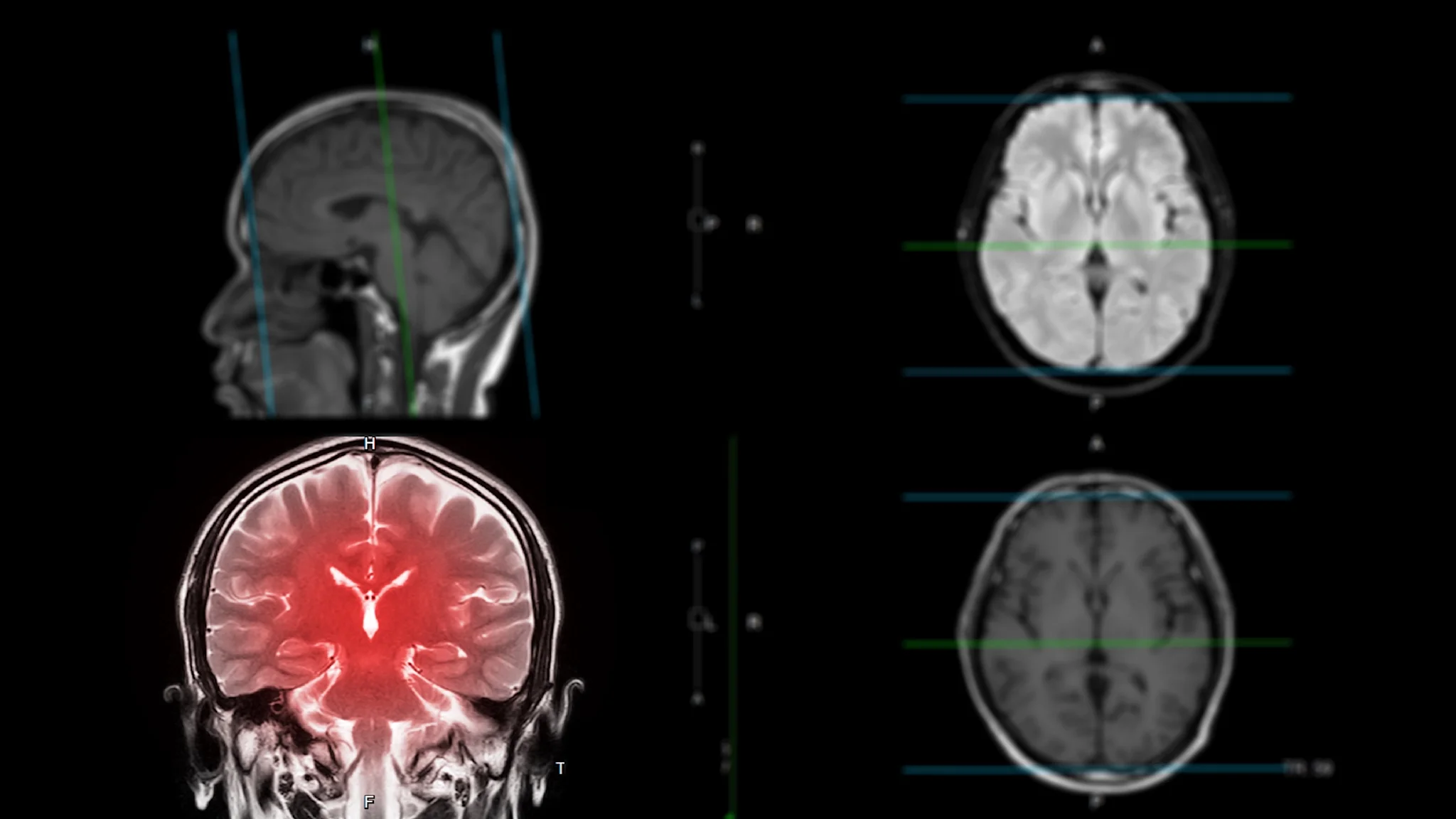 What Is Chronic Traumatic Encephalopathy? - GoodRx
