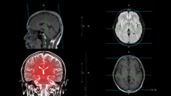 Neurological: CTE: brain scans 1409096823
