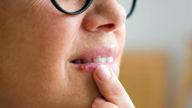 Cold sores: closeup cold sore on lip 2286218582