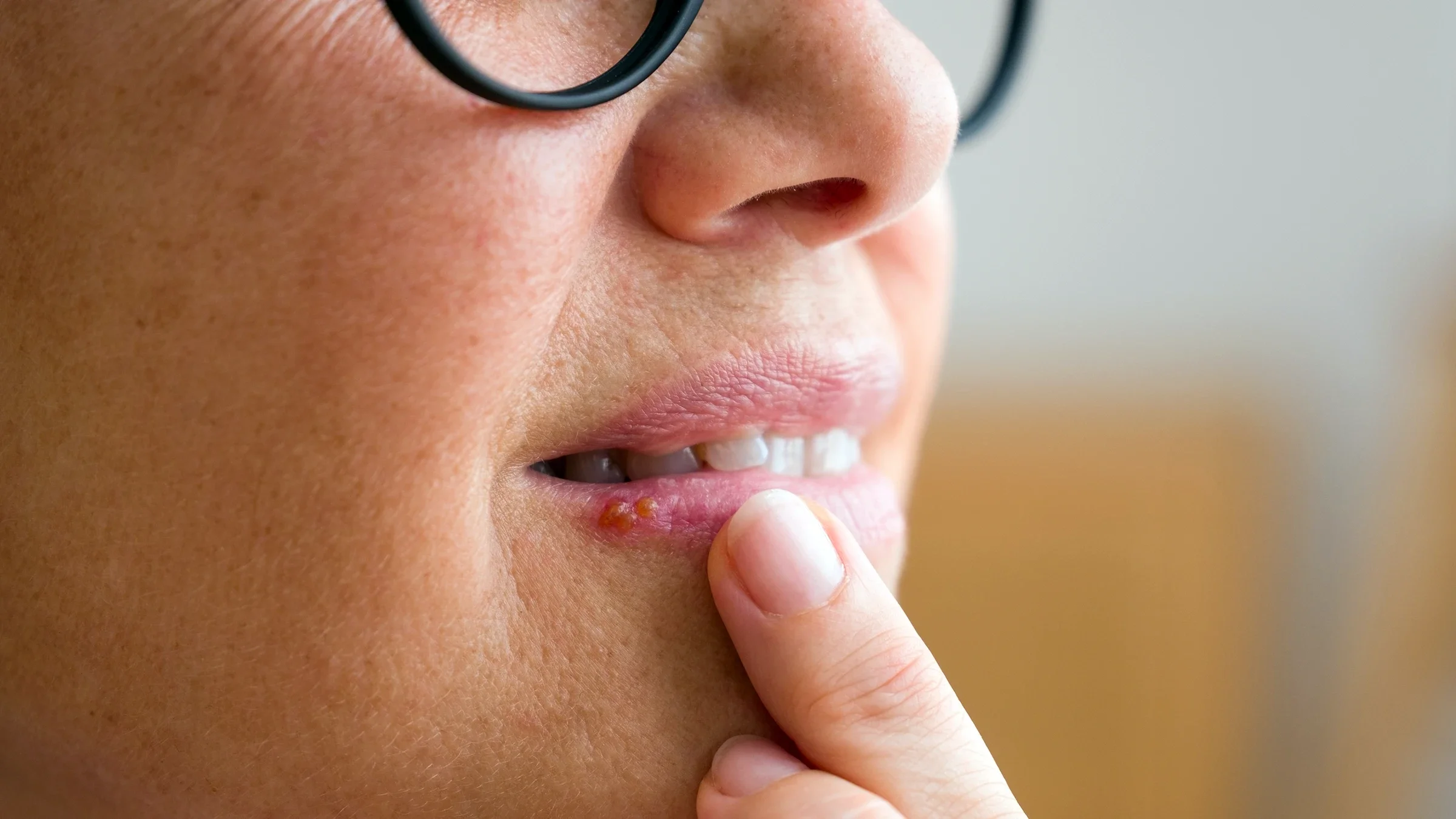 Close-up cold sore on lip.