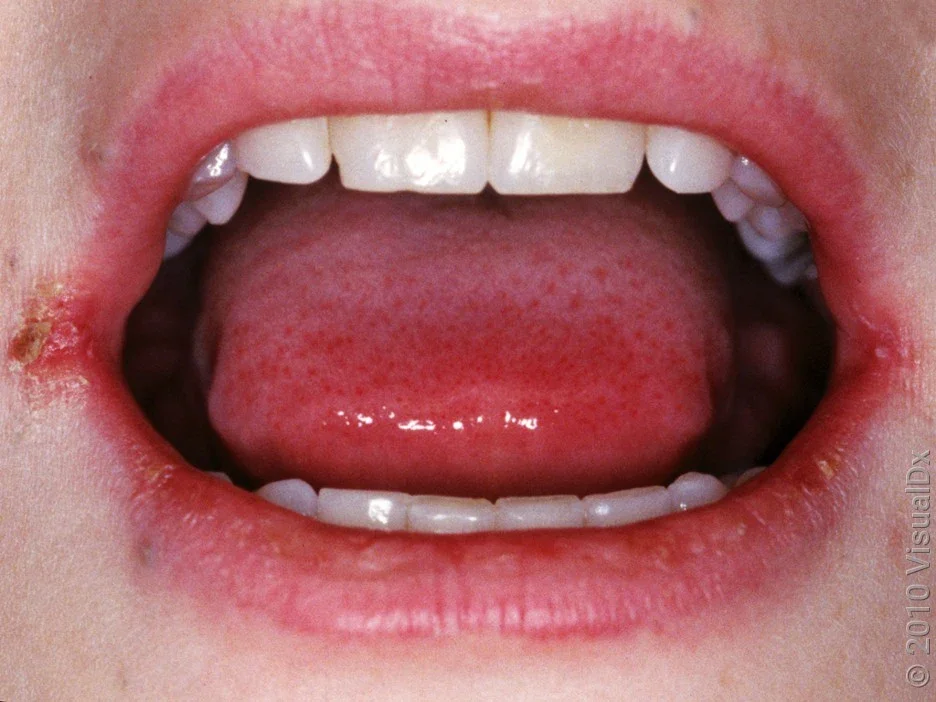 Cracked edges of lips in angular cheilitis.