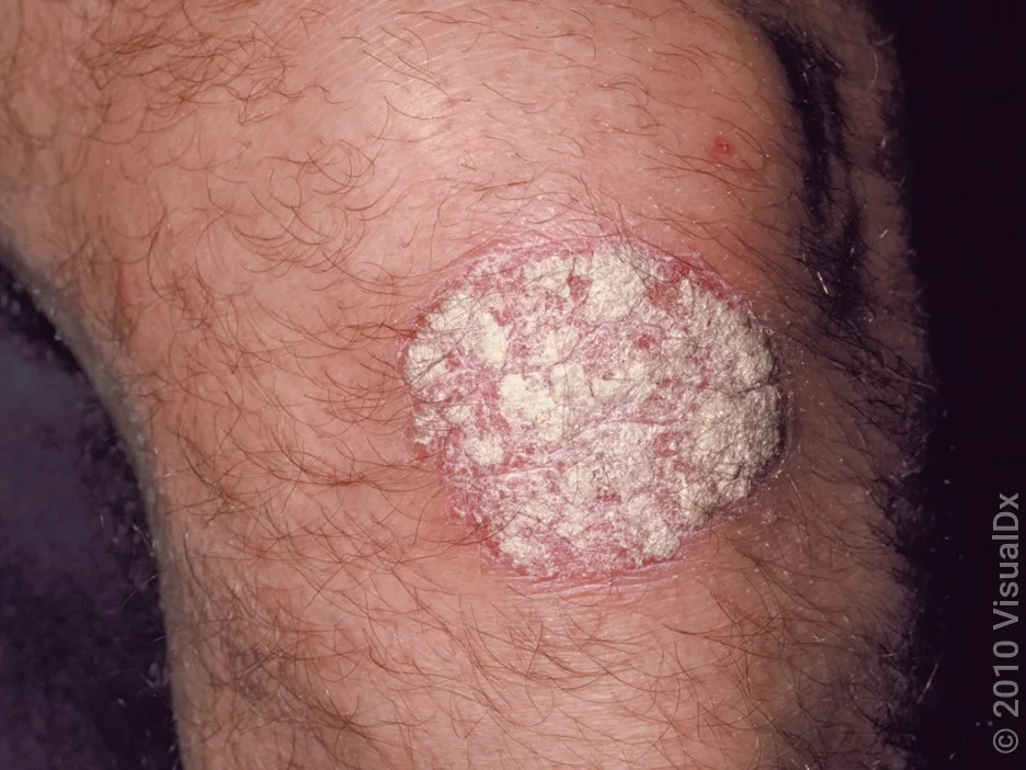 Close-up of a psoriasis plaque on the knee in fairer skin.