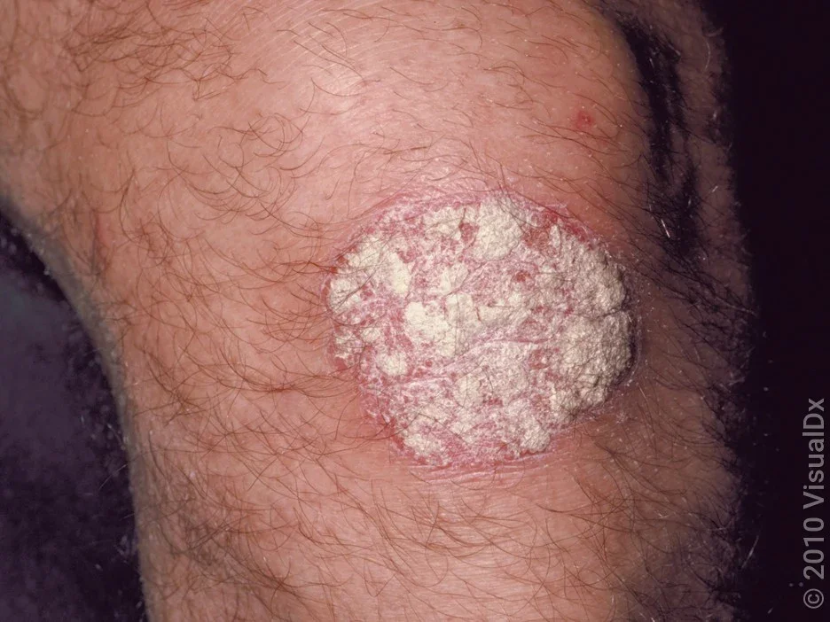 Close-up of a psoriasis plaque on the knee in fairer skin. 