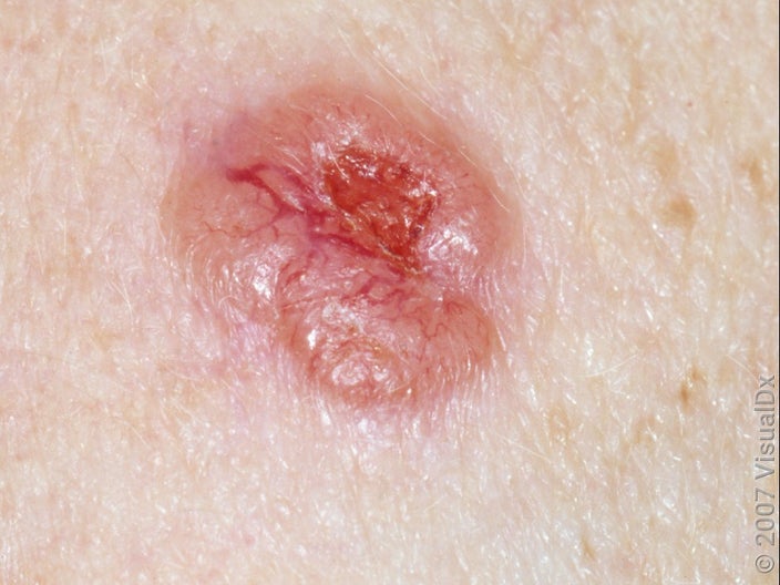 Close-up of a basal cell carcinoma skin cancer on lighter skin.