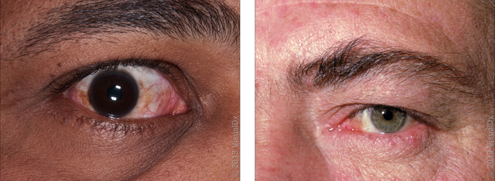 Left: Close-up of a red and inflamed eye (ocular rosacea). Right: Close-up of an eye with pink bumps along the lower eyelid.