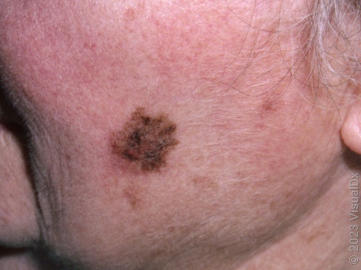 What lentigo maligna melanoma looks like on fair skin on the cheek. 