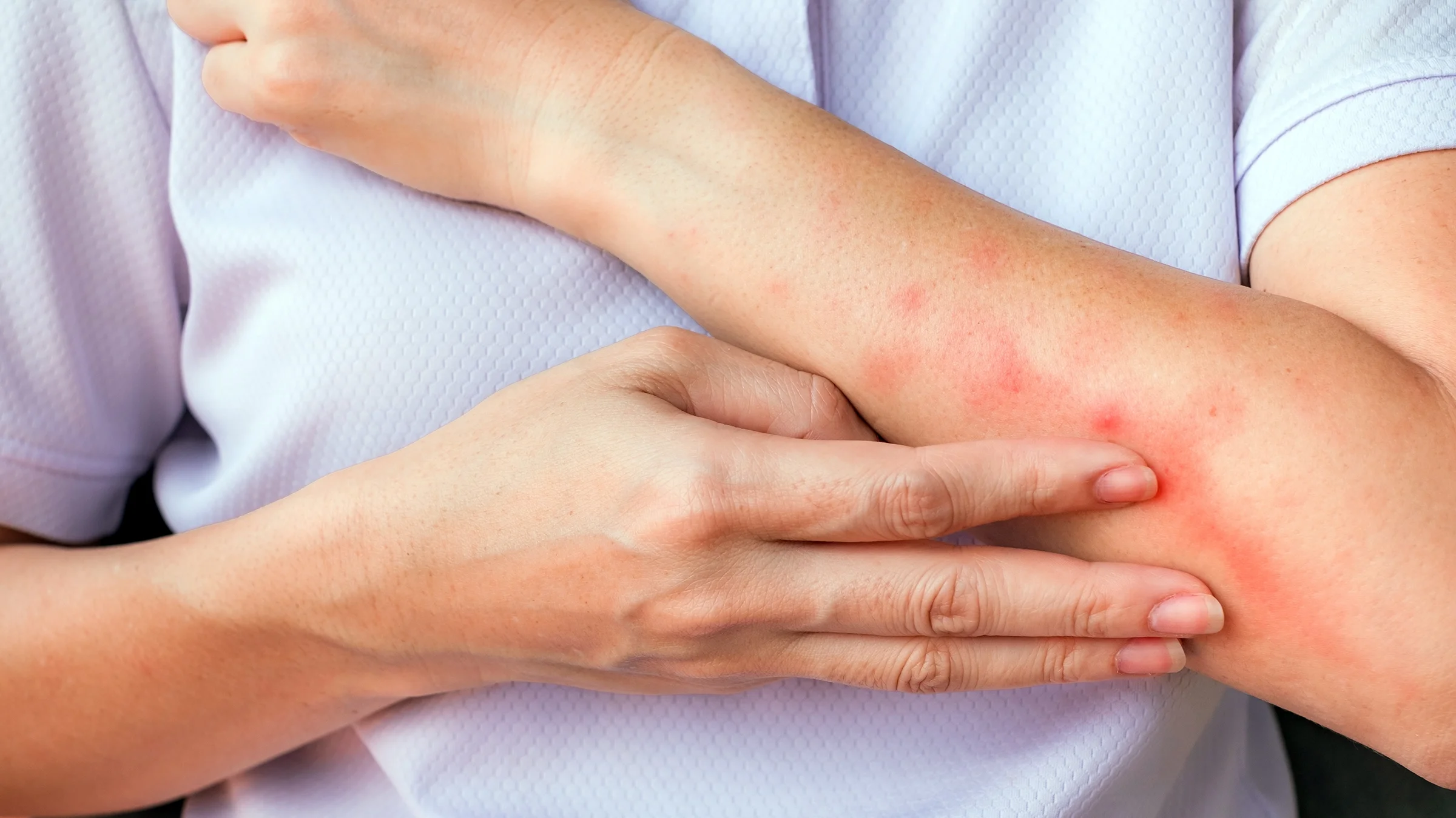 Close-up of an arm with rash