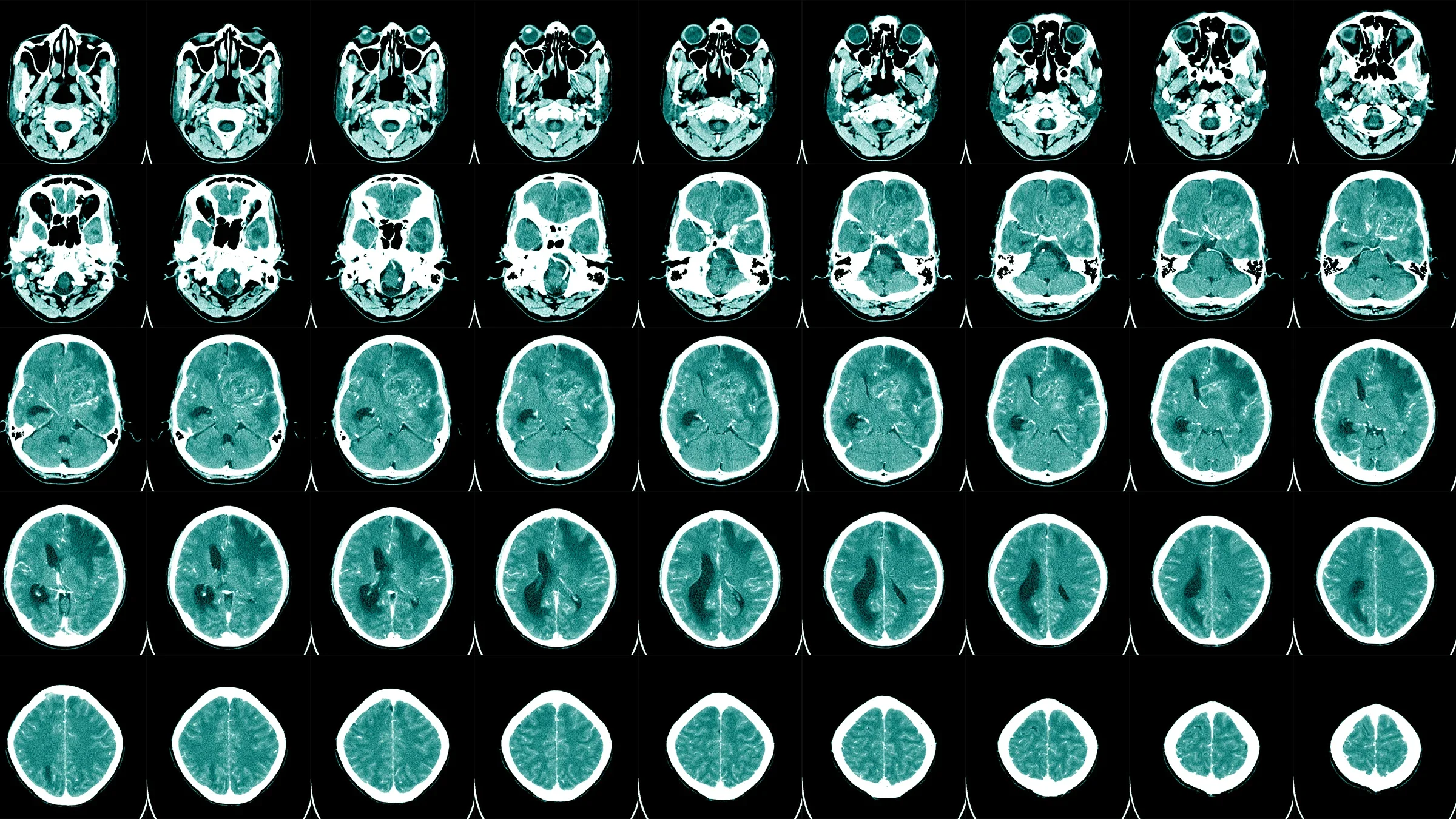 Brain scan on a light box. There are five rows of different cross sections of the brain.
Tonpor Kasa/iStock via Getty Images
