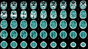 Infections: Encephalitis: brain scan grid of cross sections-1339217744