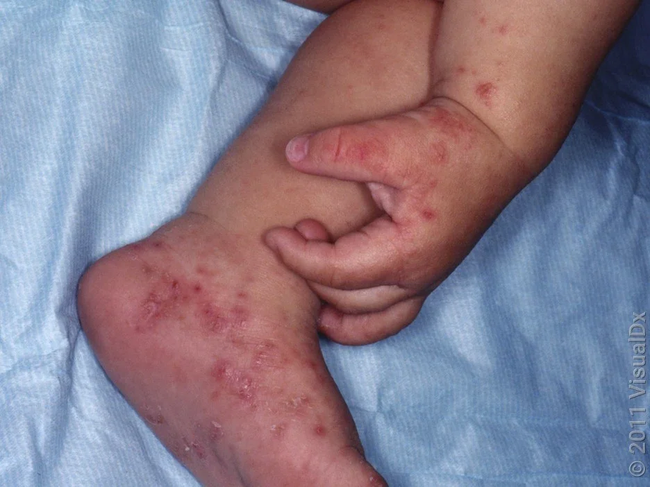 11 Common Rashes on Kids and Preschoolers (With Images) - GoodRx