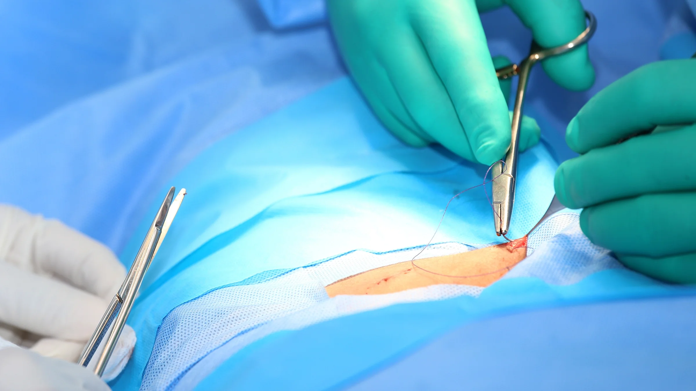 A surgeon makes a suture during a procedure.